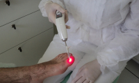 Tratamento a Laser de Micose