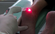 Podologia com Laser